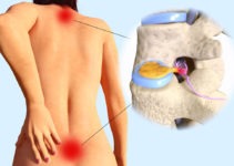 How to heal a herniated disc quickly with these guidelines