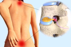 How to heal a herniated disc quickly with these guidelines