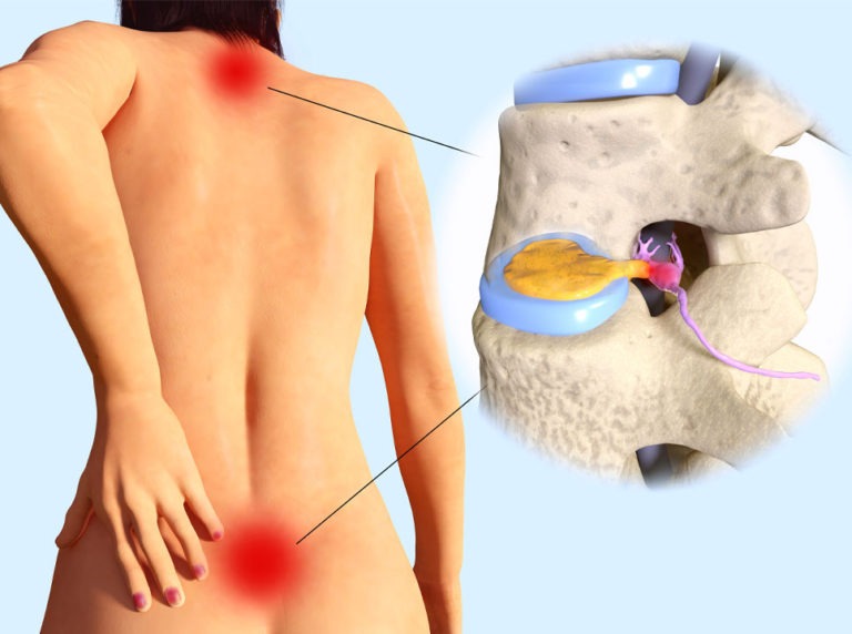 How to heal a herniated disc quickly with these guidelines