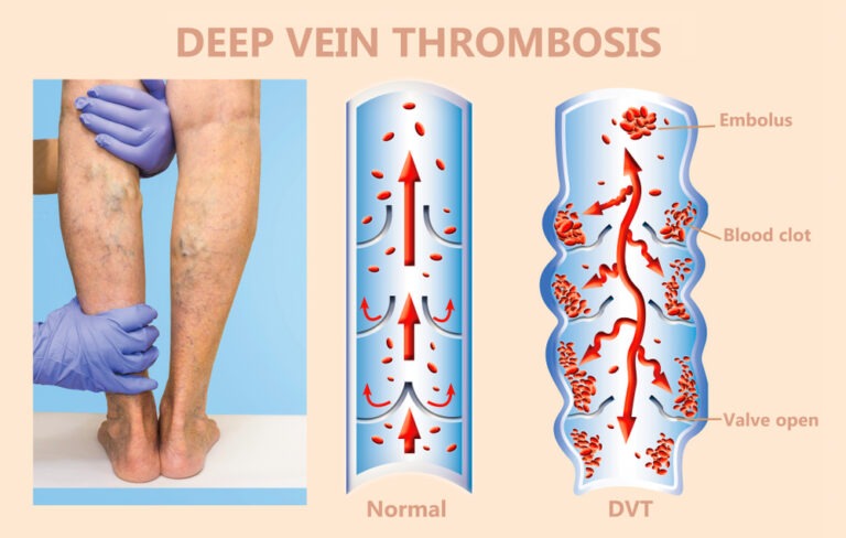 Illustration of deep vein thrombosis (DVT) in the leg veins.