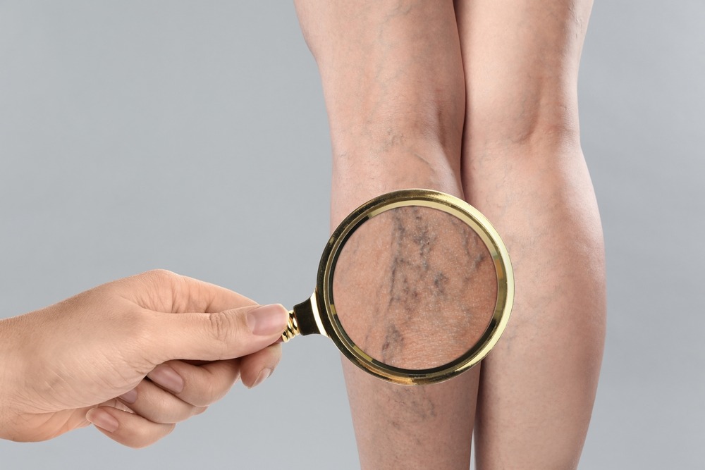 Swollen varicose veins on legs close-up